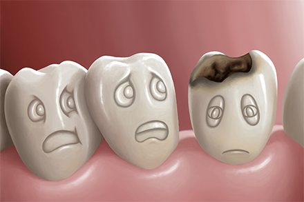 虫歯の原因のお話